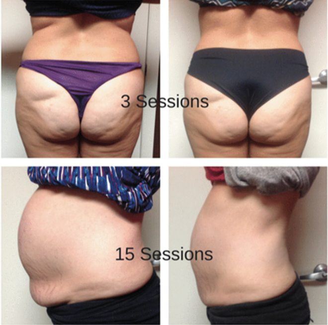 Cavi-Lipo Weight Loss, Bethlehem Tauranga | Pain-Free & Safe